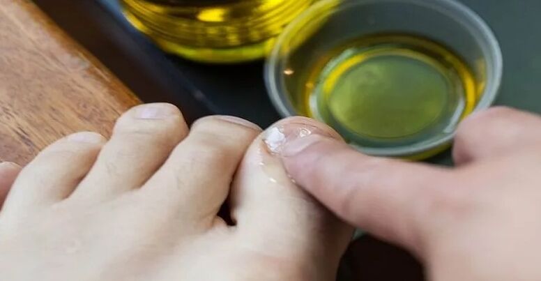 Aceites esenciais para loitar contra o fungo