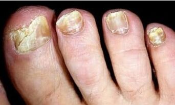 O perigo de onicomicosis