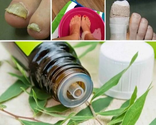 Árbore de té para fungo das uñas
