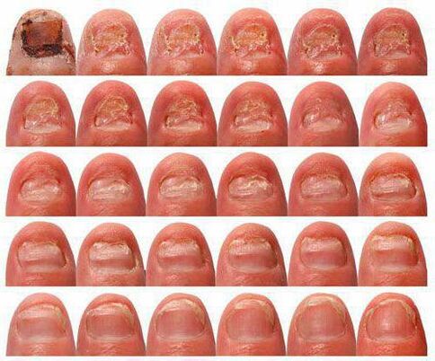 desenvolvemento da enfermidade do fungo das unhas