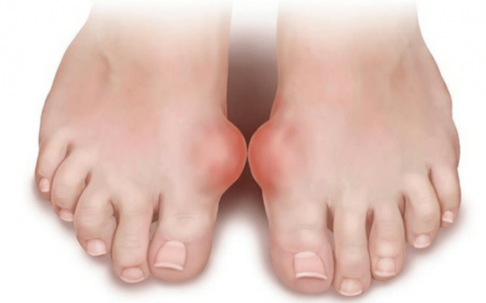 deformidade do pé como causa da aparición de fungo nas pernas