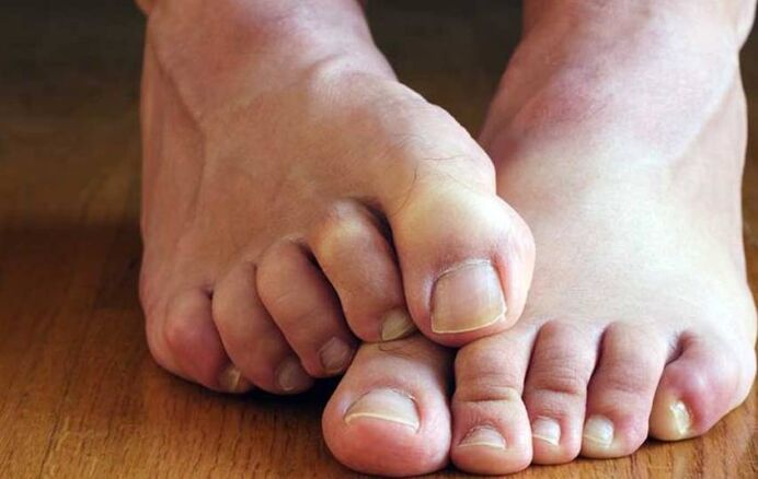 síntomas de fungo escamoso nos pés