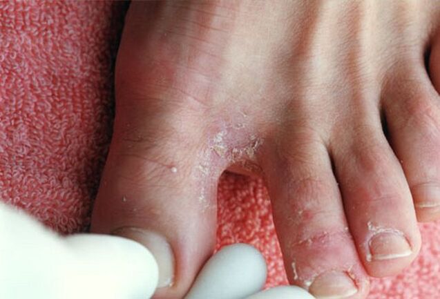 síntomas de fungo entre os dedos dos pés