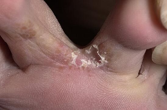 dedos dos pés afectados por fungos