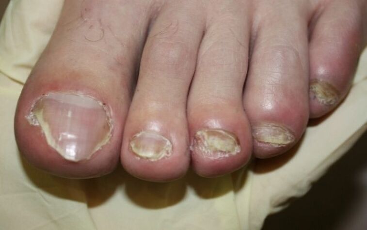 Fungo das uñas