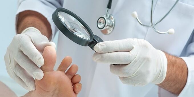 O médico examinou o pé infectado cun fungo