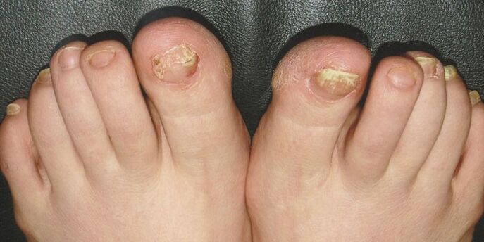 Onicomicosis das uñas nas pernas
