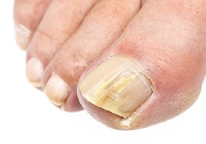 Como é o fungo das uñas