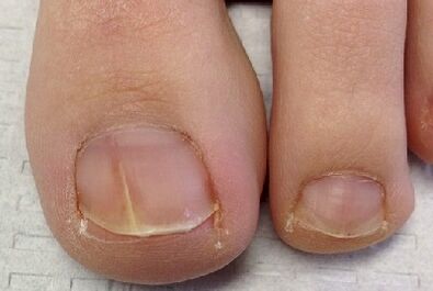 Fungo das uñas de dedo