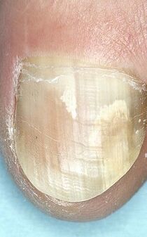 Fungo das uñas