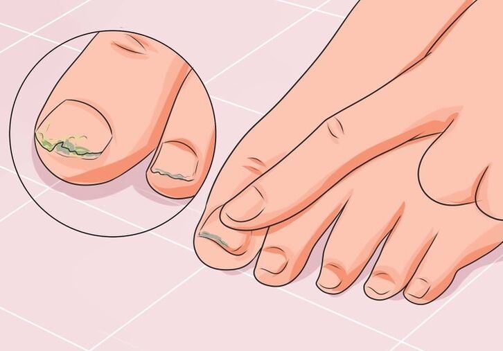como tratar o fungo das unhas do pé con gotas
