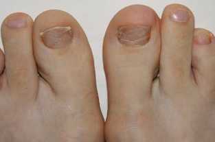 Os síntomas do fungo do pé